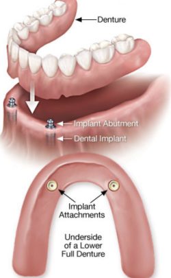 Implant denture